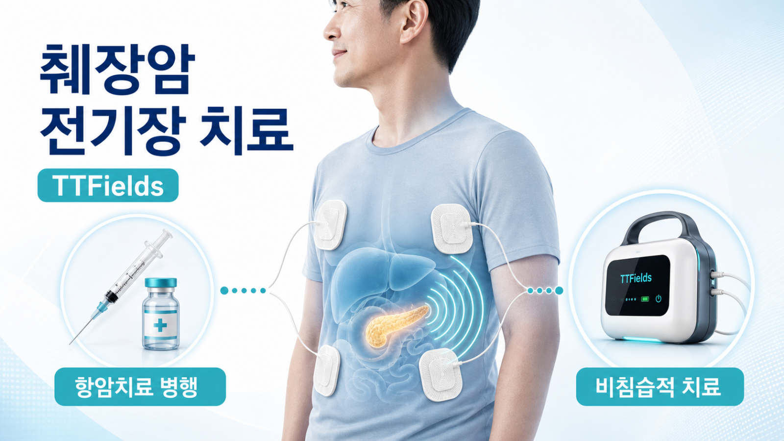 췌장암 치료, ‘전기장 치료’라는 새 선택지가 등장하다